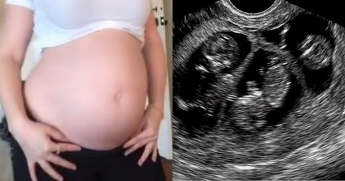 Hy hữu: Đang mang bầu cặp song sinh, mẹ trẻ tiếp tục có thai