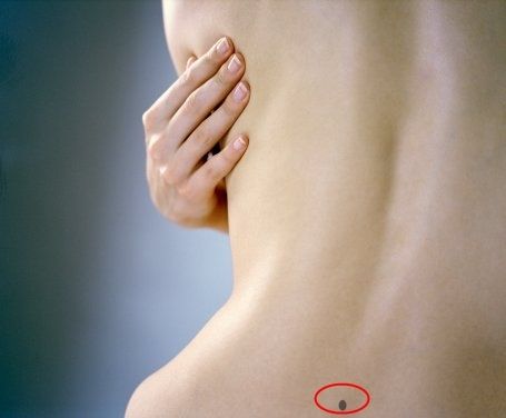 5 vị trí nốt ruồi trên lưng tiết lộ cuộc sống bạn