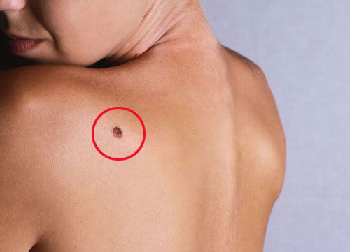 5 vị trí nốt ruồi trên lưng tiết lộ cuộc sống bạn