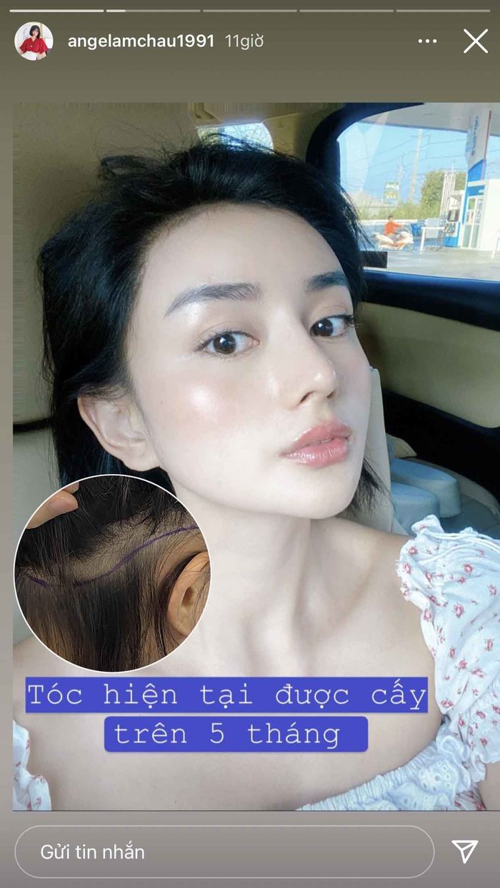 Để che khuyết điểm chân tóc: Hari Won dập phồng, Lynk Lee phải cắt da