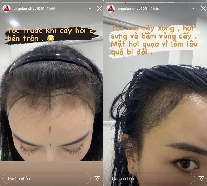 Để che khuyết điểm chân tóc: Hari Won dập phồng, Lynk Lee phải cắt da