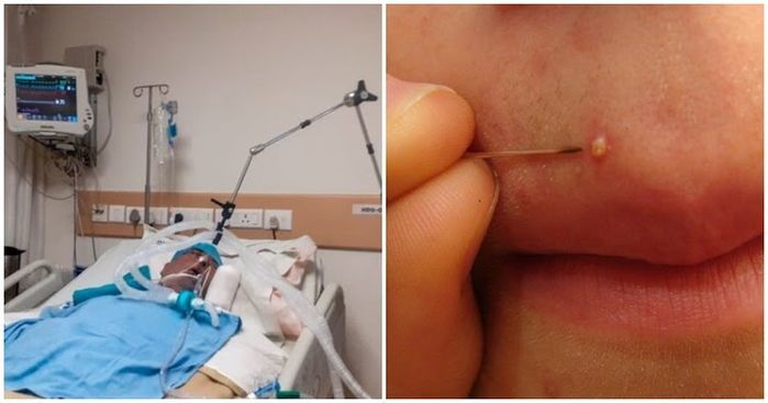 Nặn mụn đầu đen, mẹ trẻ mặt sưng vù, nguy cơ ảnh hưởng đến thị giác