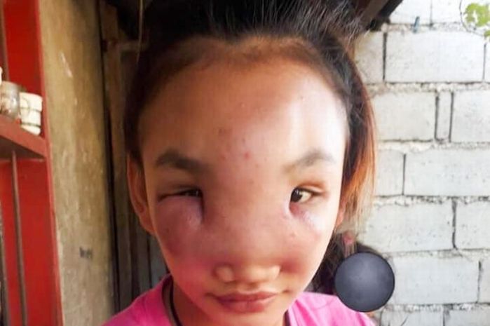 Nặn mụn đầu đen, mẹ trẻ mặt sưng vù, nguy cơ ảnh hưởng đến thị giác