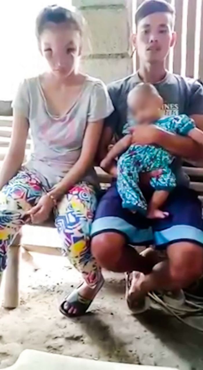 Nặn mụn đầu đen, mẹ trẻ mặt sưng vù, nguy cơ ảnh hưởng đến thị giác