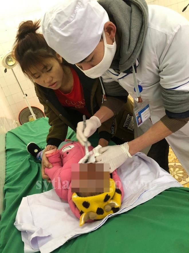 Lào Cai: Hai bé chưa đầy 1 tuổi ngã úp mặt vào bếp than