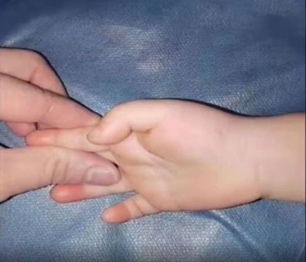 Bé 3 tuổi không thể duỗi thẳng ngón tay vì dùng điện thoại