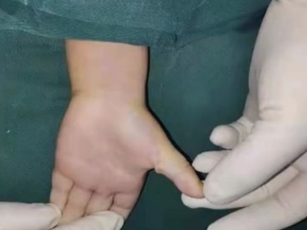 Bé 3 tuổi không thể duỗi thẳng ngón tay vì dùng điện thoại