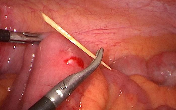 Bệnh nhi bị tăm đâm thủng ruột do ăn ốc