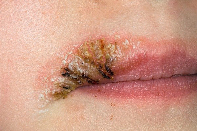 Cô gái bị biến chứng nguy hiểm vì xăm môi