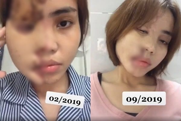 Cô gái bị tạt axit đã phục hồi nhan sắc sau 2 năm