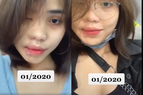 Cô gái bị tạt axit đã phục hồi nhan sắc sau 2 năm