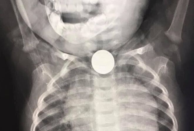 Bé 2 tuổi nuốt pin cúc áo được cấp cứu bằng mật ong kịp thời