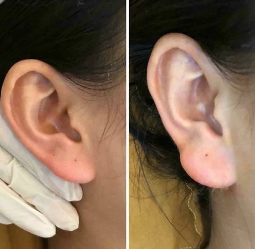 Nữ doanh nhân 35 tuổi bị biến dạng tai vì làm tai Phật