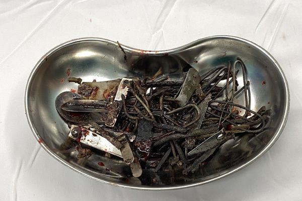 Bình Dương: Nam thanh niên 27 tuổi nuốt ổ dị vật nặng 1 kg