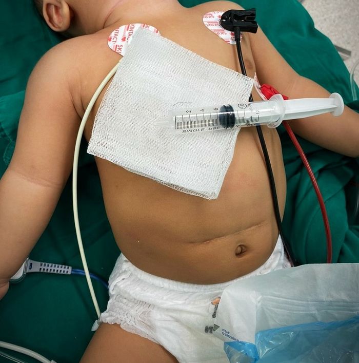 Ăn dặm cháo mẹ rây, bé 8 tháng tuổi bị hóc dị vật nguy hiểm
