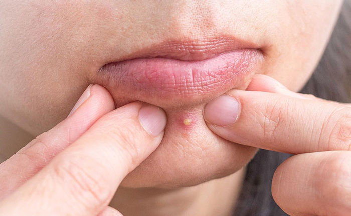 Quý ông nguy kịch vì biến chứng viêm phổi nặng do nặn mụn