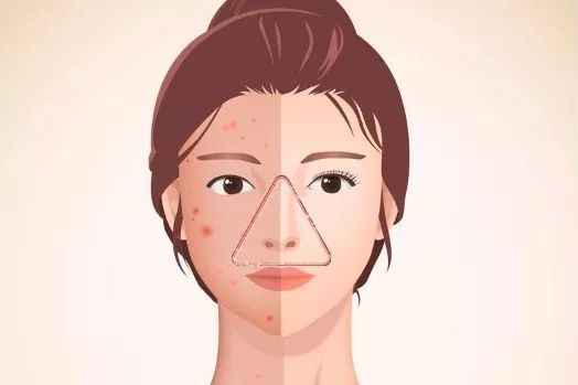 Quý ông nguy kịch vì biến chứng viêm phổi nặng do nặn mụn