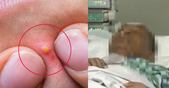 Quý ông nguy kịch vì biến chứng viêm phổi nặng do nặn mụn