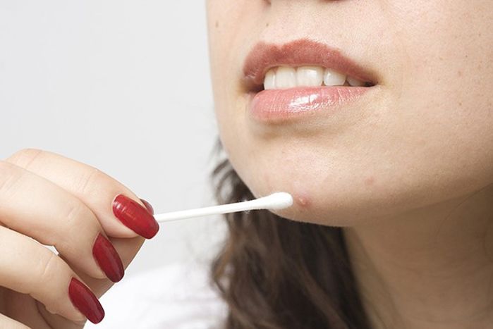 Quý ông nguy kịch vì biến chứng viêm phổi nặng do nặn mụn
