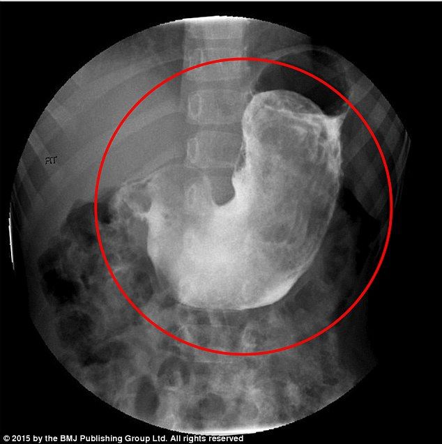 Bé gái ở TP.HCM bị tắc ruột vì nghiện ăn tóc