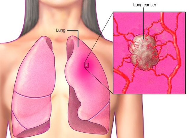 5 bệnh nan y có tính di truyền cao, người thân từng bị càng nên chú ý
