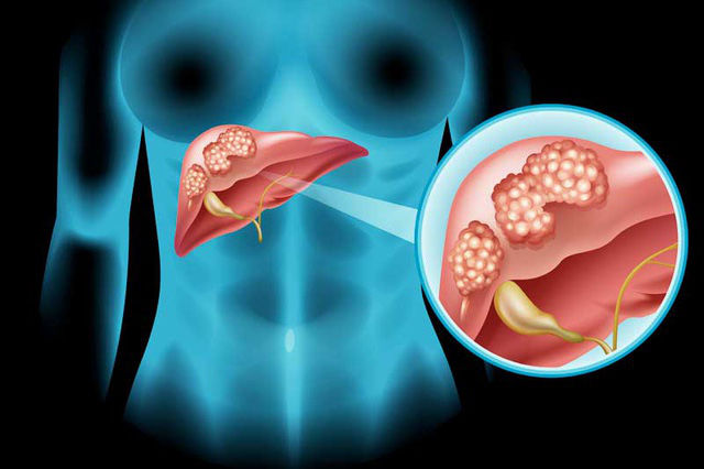 5 bệnh nan y có tính di truyền cao, người thân từng bị càng nên chú ý
