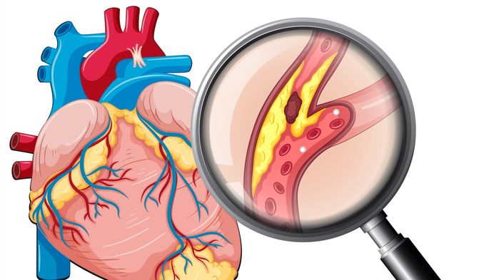 7 dấu hiệu cảnh báo tắc nghẽn động mạch, người trẻ càng cần chú ý
