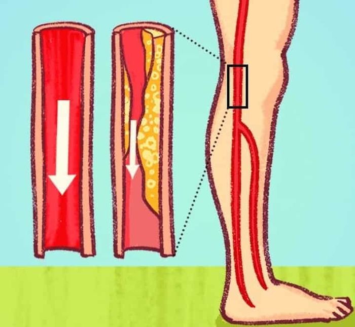 7 dấu hiệu cảnh báo tắc nghẽn động mạch, người trẻ càng cần chú ý