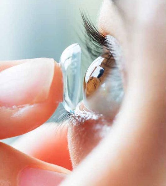 Cô gái bị viêm kết mạc, chảy dịch nghi do dùng lens kém chất lượng