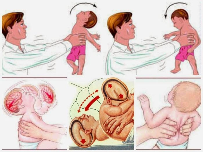 Bé 9 tháng tuổi bị bại não vì bà lắc lư quá mạnh và nhiều