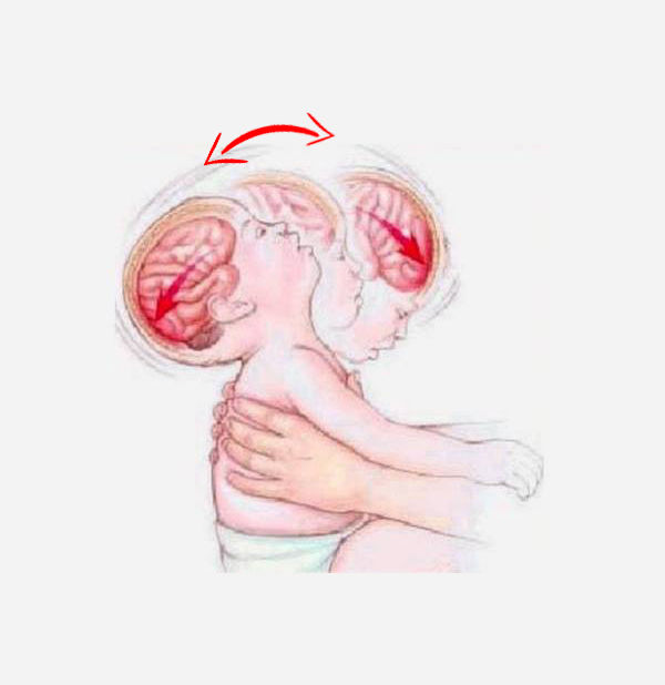 Bé 9 tháng tuổi bị bại não vì bà lắc lư quá mạnh và nhiều