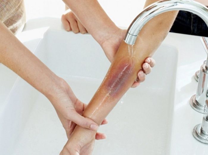 Bé 9 tháng tuổi không qua khỏi vì nhiễm trùng bỏng