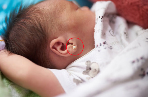 Bé gái 2 tuổi nhiễm trùng nặng vì đeo bông tai