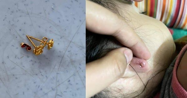 Bé gái 2 tuổi nhiễm trùng nặng vì đeo bông tai