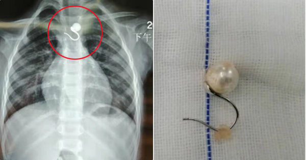 Bé gái 2 tuổi nhiễm trùng nặng vì đeo bông tai
