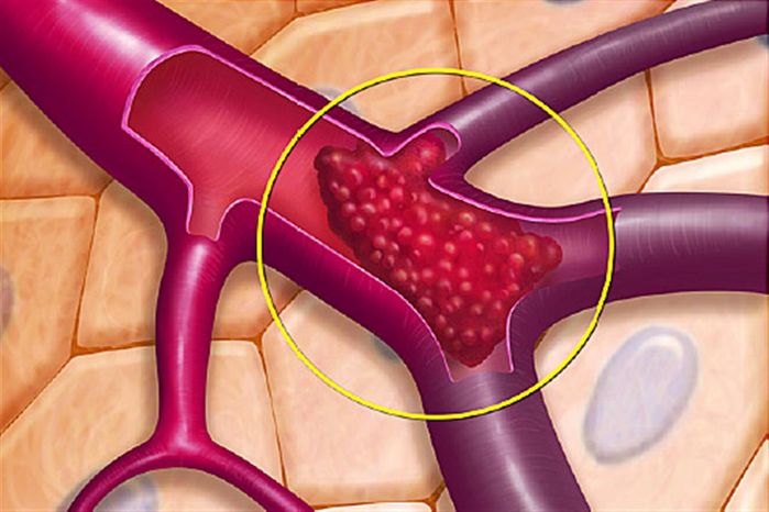 BS chỉ ra dấu hiệu cục máu đông từ 2 cơn đau, 2 vết đỏ và 2 nếp gấp