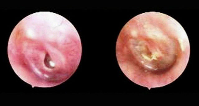 Tự ráy tai có thể nhiễm trùng não và điếc