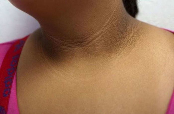 Cậu bé có vạch màu đen trên cổ, tưởng da bẩn hóa ra bệnh gai đen