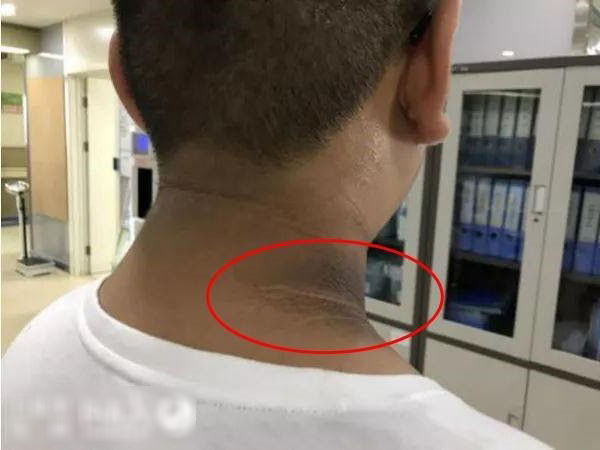 Cậu bé có vạch màu đen trên cổ, tưởng da bẩn hóa ra bệnh gai đen
