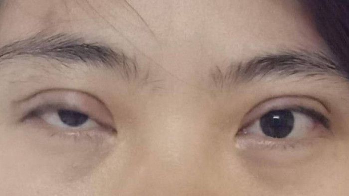 Cô gái 23 tuổi bị mù mắt trái, mắt phải bị bóng mờ vì cắt mí ở spa