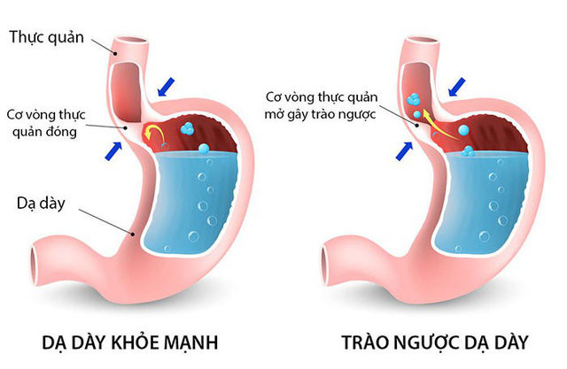 Cô gái 20 tuổi mắc trào ngược dạ dày vì bỏ bữa sáng