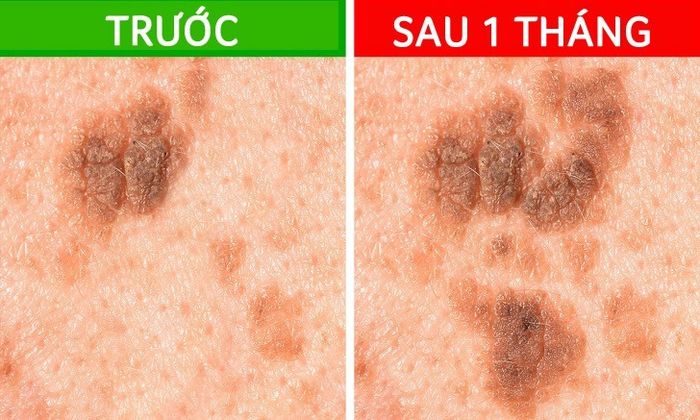 Những nốt ruồi báo hiêu mầm bệnh nan y