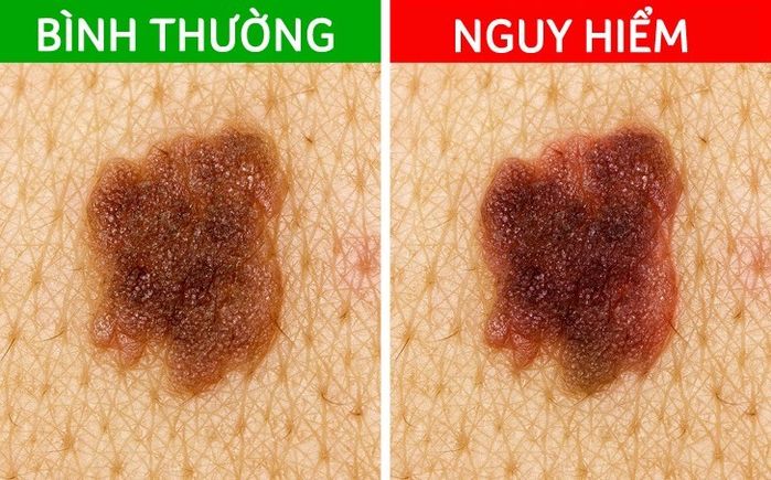 Những nốt ruồi báo hiêu mầm bệnh nan y