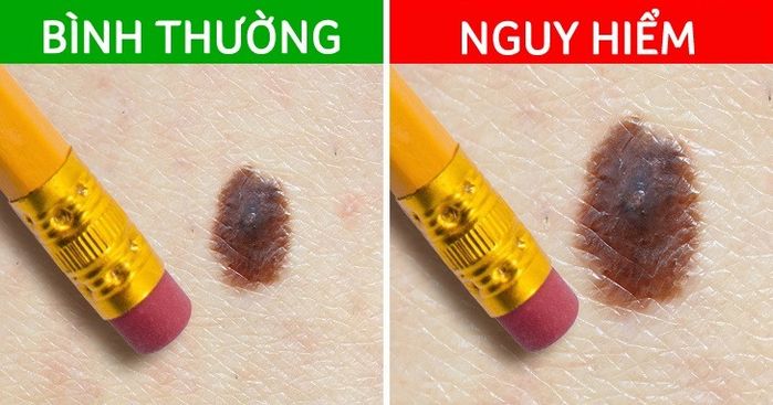 Những nốt ruồi báo hiêu mầm bệnh nan y