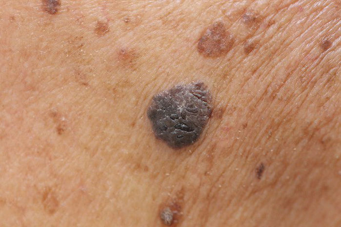 Những nốt ruồi báo hiêu mầm bệnh nan y