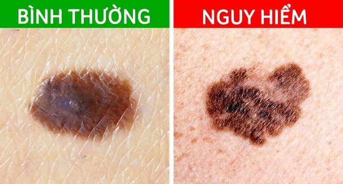Những nốt ruồi báo hiêu mầm bệnh nan y