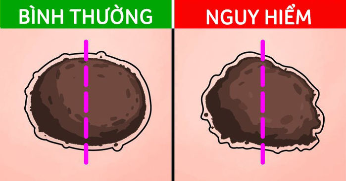 Những nốt ruồi báo hiêu mầm bệnh nan y