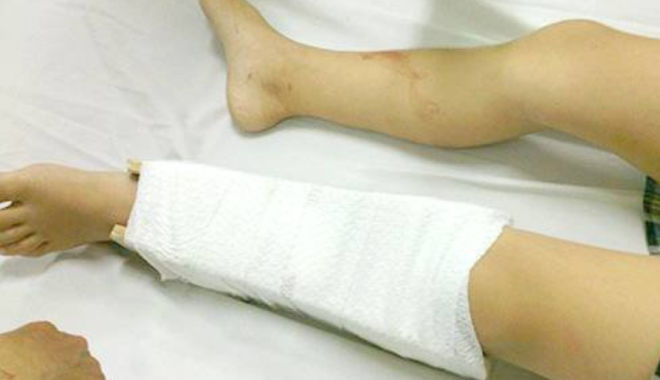 Tông trai đẹp khiến anh gãy chân, cô gái đến chăm rồi yêu luôn