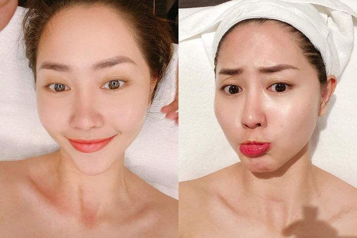 Nhan sắc của Tường Vi sau khi dằn vặt vì sửa mũi hỏng