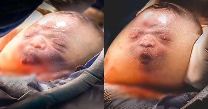 Em bé bĩu môi trong túi ối cách đây 2 năm, giờ kháu khỉnh, đáng yêu